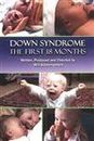 Down Syndrome: The First 18 Months